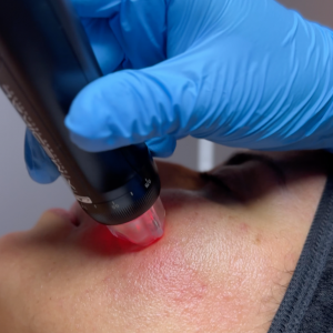 Orion XPro: rejuvenecimiento facial inmediato