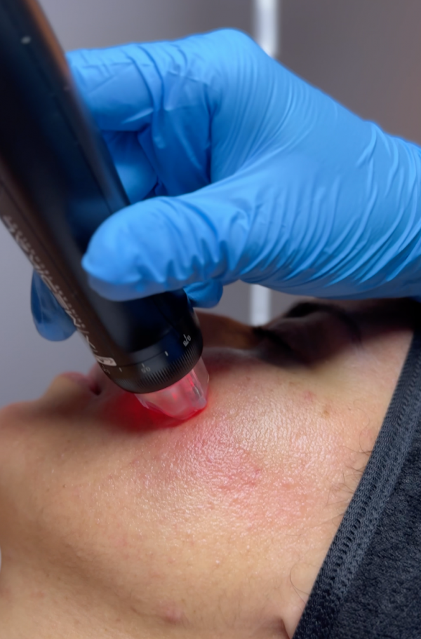 Orion XPro: rejuvenecimiento facial inmediato