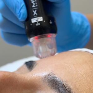 Orion XPro: rejuvenecimiento facial inmediato