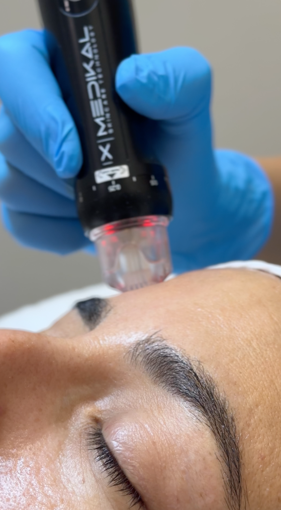 Orion XPro: rejuvenecimiento facial inmediato