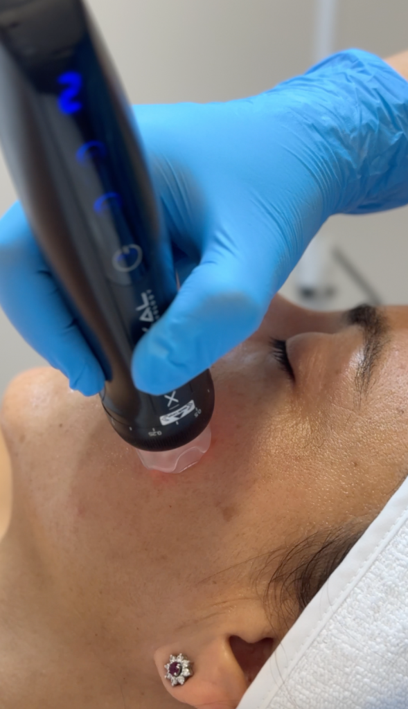 Orion XPro: rejuvenecimiento facial inmediato