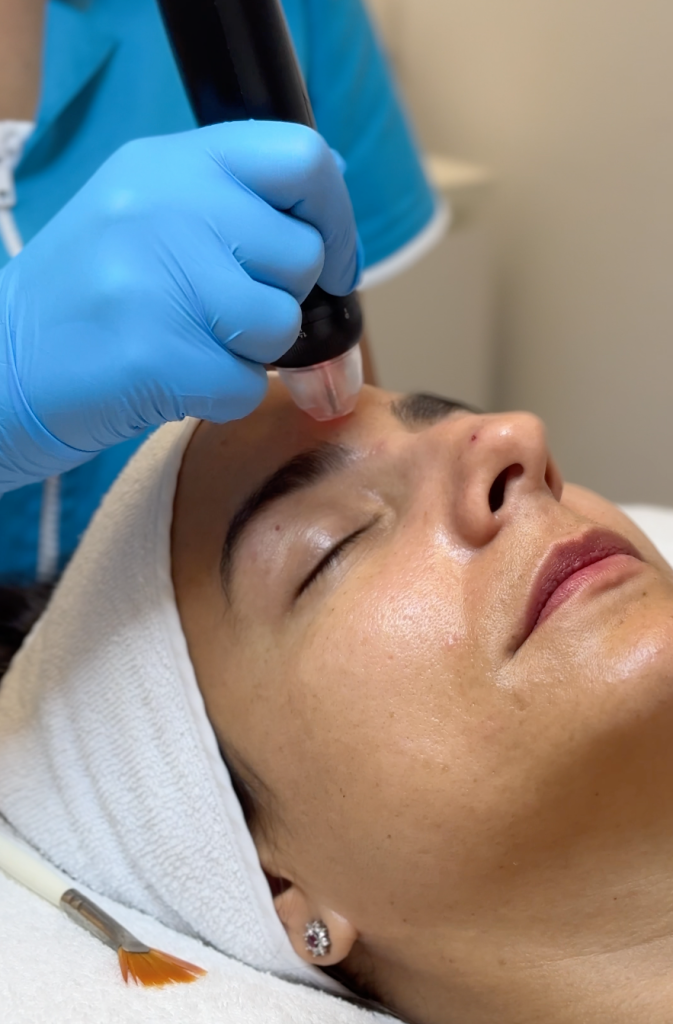 Orion XPro: rejuvenecimiento facial inmediato