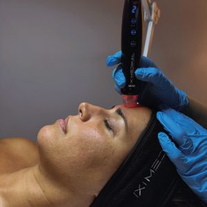 Orion XPro: rejuvenecimiento facial inmediato
