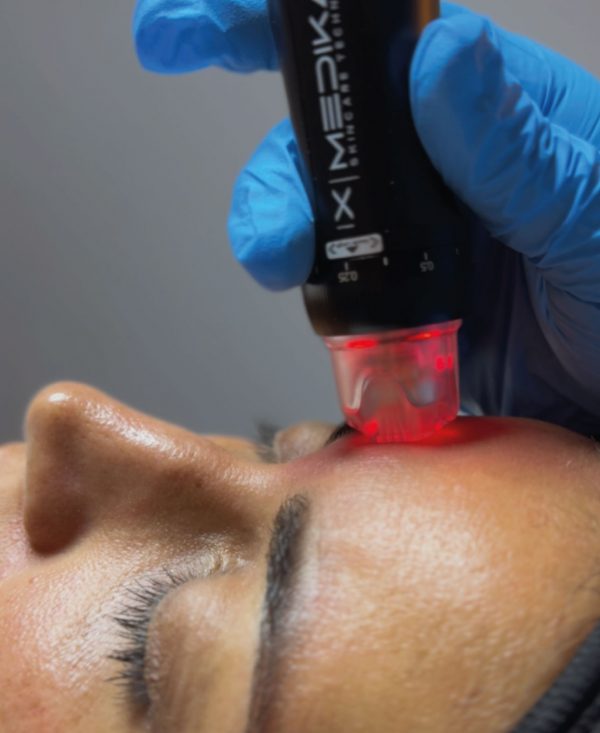 Orion XPro: rejuvenecimiento facial inmediato - Imagen 4