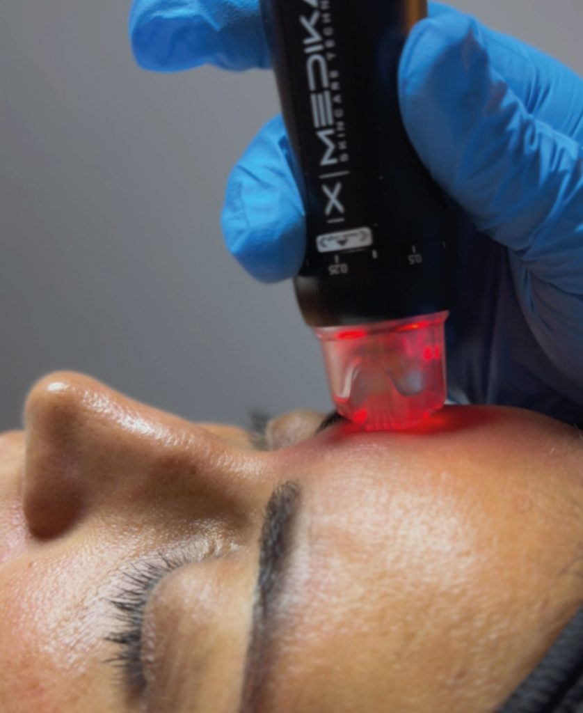 Orion XPro: rejuvenecimiento facial inmediato
