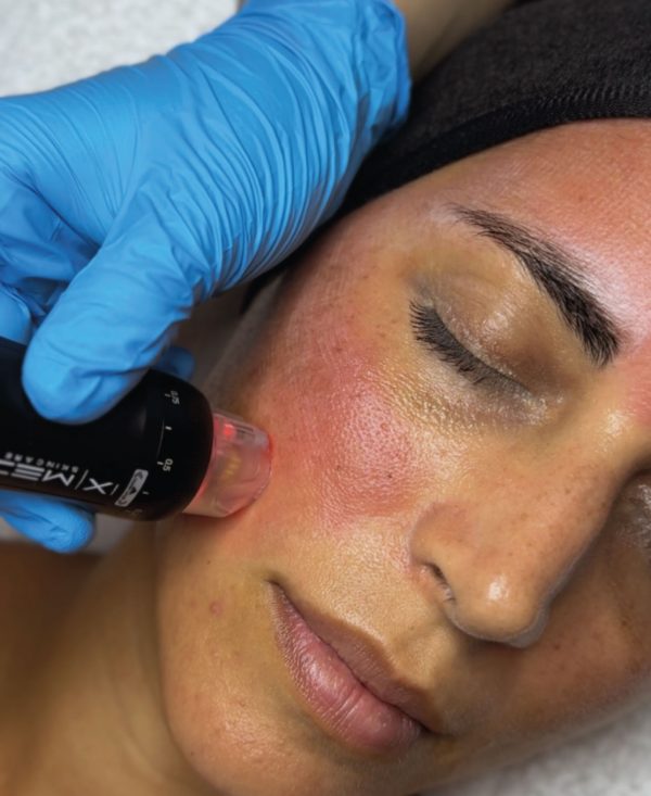 Orion XPro: rejuvenecimiento facial inmediato - Imagen 2
