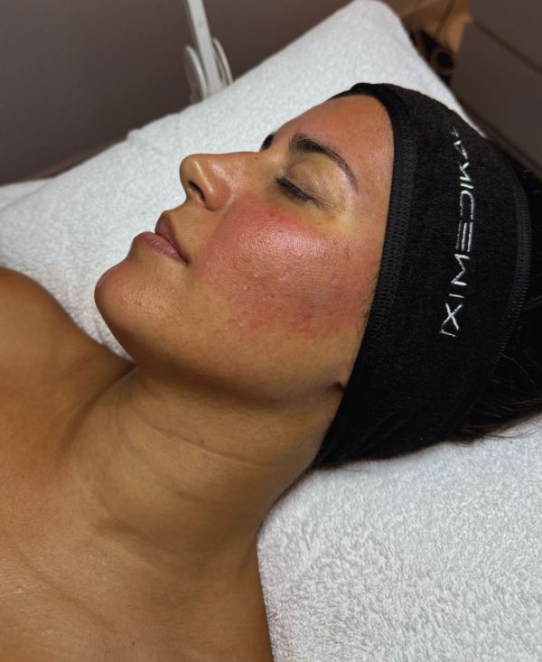 Orion XPro: rejuvenecimiento facial inmediato - Imagen 3